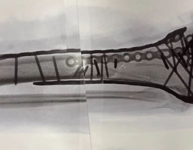 Miniatura: Lindsey Vonn przeszła koszmar. Odkryła...